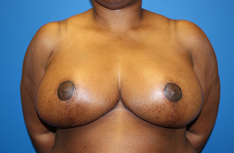 Breast Reduction Before and After 09