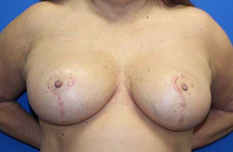 Breast Reduction Before and After 10