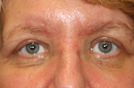 Brow Lift Before and After 01