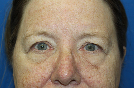 Eyelid Surgery Charlotte
