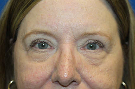 Eyelid Surgery Charlotte