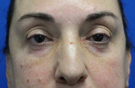 Eyelid Lift Before and After 01