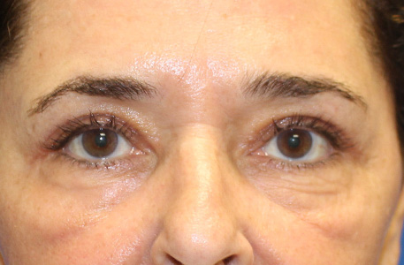 Eyelid Lift Before and After 02