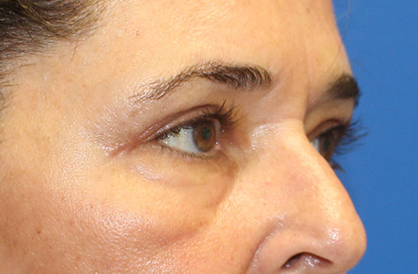 Eyelid Lift Before and After 03