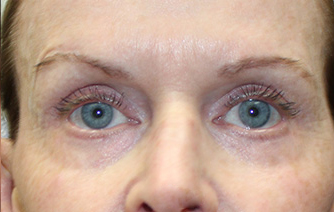 Eyelid Lift Before and After 01