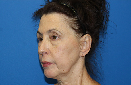 Facelift Before and After 02