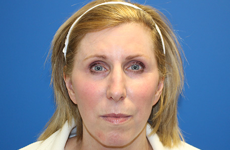 Facelift Before and After 11