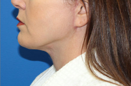 Neck Lift Before and After 08