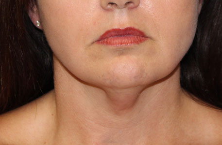 Neck Lift Before and After 02