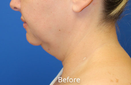 Neck Lift Before and After 04