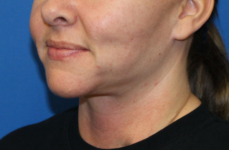 Neck Lift Before and After 04