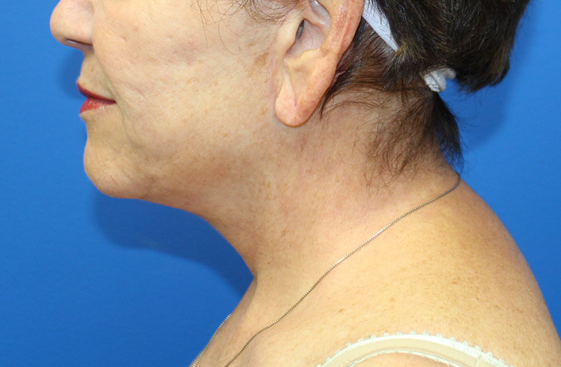 Neck Lift Before and After 01