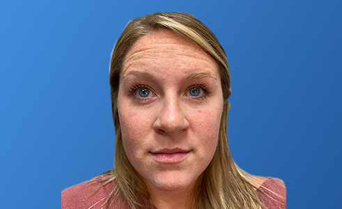Botox Xeomin Before and After 02