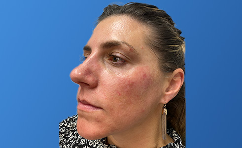 Filler Before and After 03