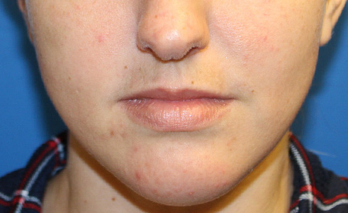 Filler Before and After 04