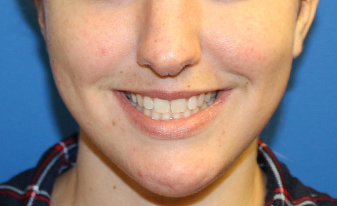 Filler Before and After 04
