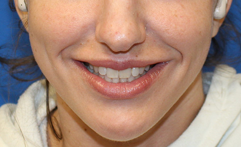 Filler Before and After 04