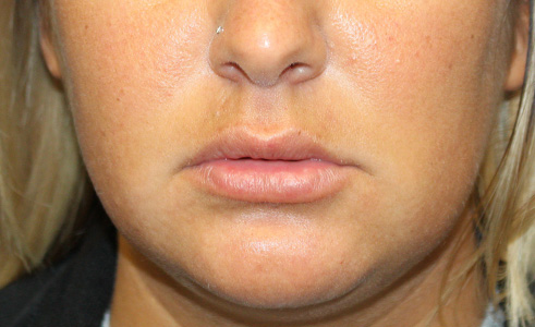 Filler Before and After 05