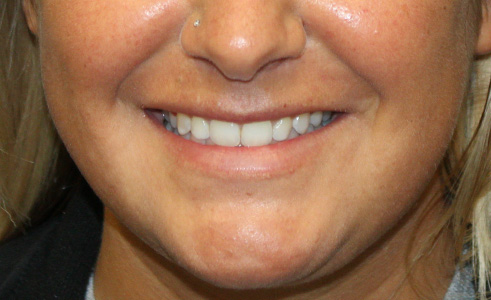 Filler Before and After 05