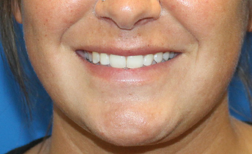 Filler Before and After 05