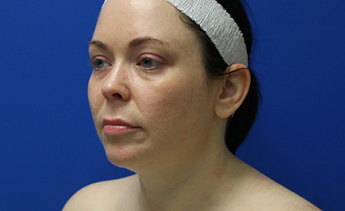 Halo Laser Before and After 03