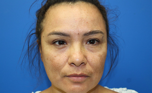 Halo Laser Before and After 04