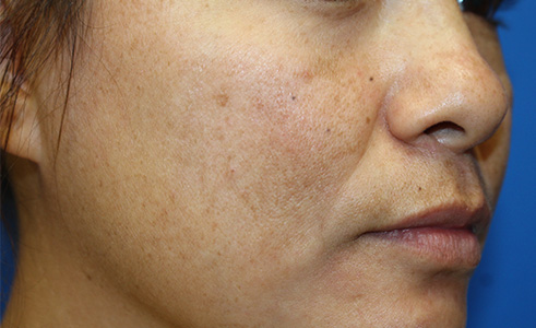 Halo Laser Before and After 04