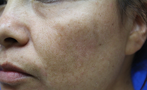 Halo Laser Before and After 04