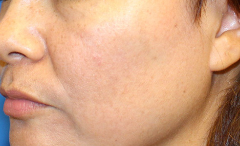 Halo Laser Before and After 04