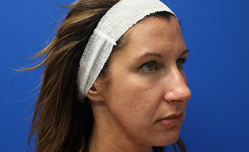 Halo Laser Before and After 05