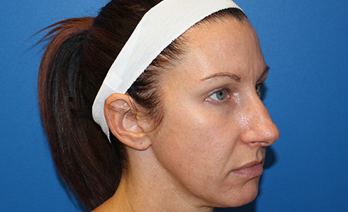 Halo Laser Before and After 05