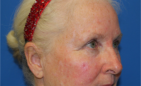 Laser Rosacea Before and After 01