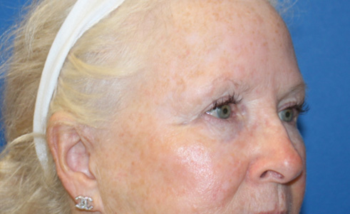 Laser Rosacea Before and After 01